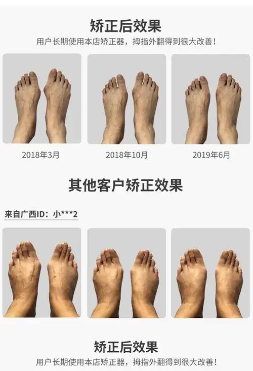 拇指外翻大脚骨器带脚趾分趾器纠正袜可穿鞋男女兼用一对均码