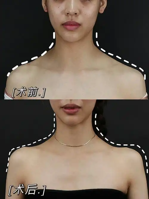 术前诊断斜方肌发达,肩部不对称方案设计瘦肩针手术总_圈子-新氧美容