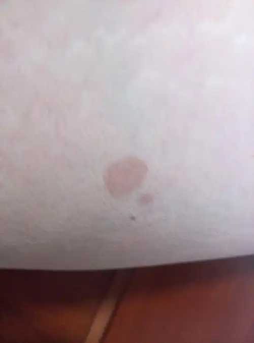 1,两年前腋下长了这样的斑,褐色,圆形,和硬币一样大,不痛不痒,有长大
