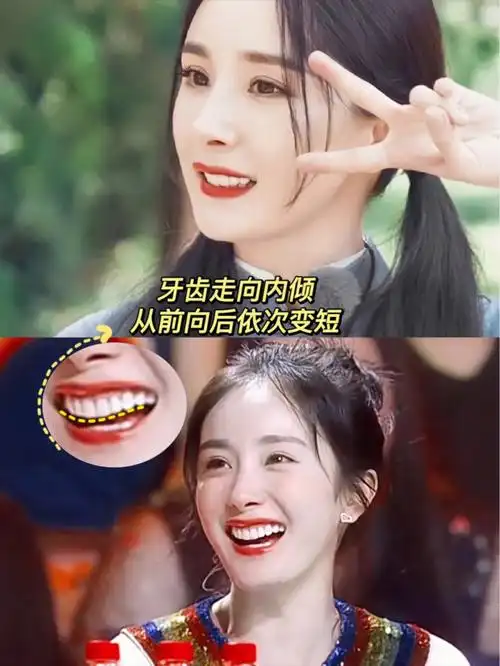 杨幂牙齿矫正后蕞大的特点是牙齿的走向有点内倾,牙齿长度从前向后