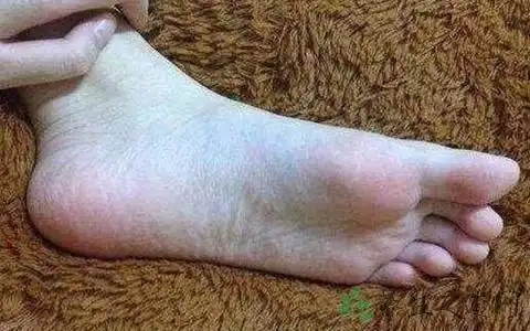 前脚掌麻木的原因_医学健康_养生之道网