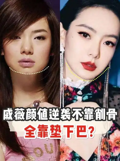 戚薇之前可以说是下巴后缩重度患者了,自从换了个下巴,戚薇的颜值就