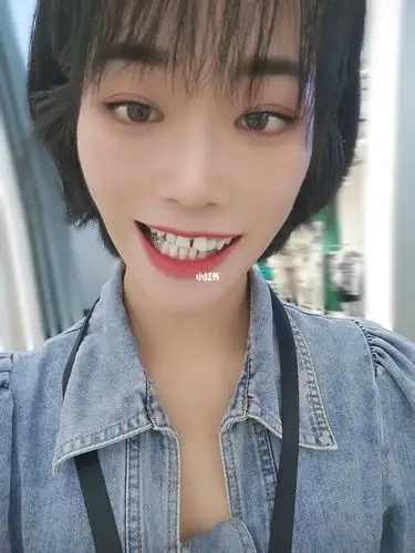 带牙套三个月出现明显的牙套脸_牙套_牙套脸_邵阳市自由行热门攻略