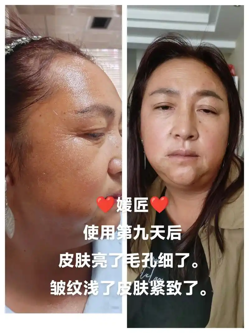 如果你皮肤暗黄暗沉,毛孔粗大,痘痘坑坑,脓包痘痘,斑斑点点,角质层薄