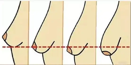 19岁女生有些胸下垂怎么才可以恢复? - 知乎