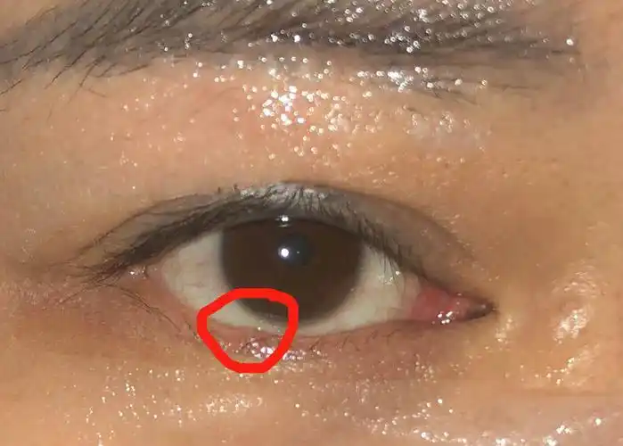 下眼皮里面这是什么 有没有什么病