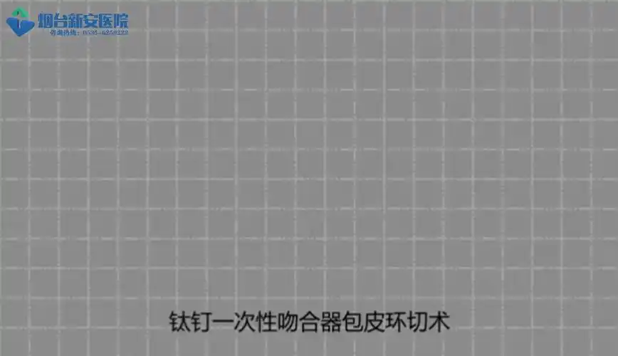 钛钉一次性吻合器环切术治包皮包茎