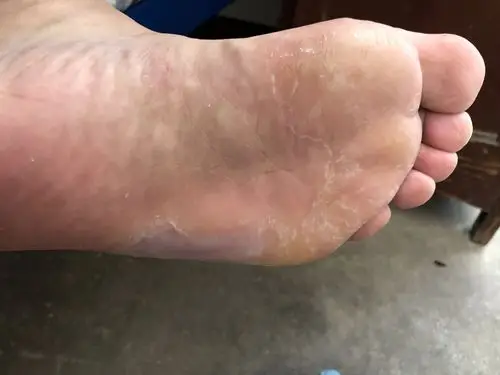 为啥脚底板的角质层刮掉后还会张?_百度知道