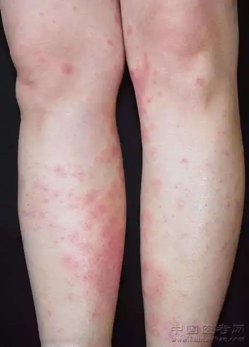 史上最全的皮肤病图谱来了(修订版)!