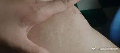 腰腹吸脂半个月后肚子有折痕会不会是因为皮肤松弛所导致的