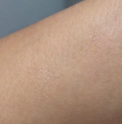 问:手臂起鸡皮疙瘩状的东西,一块一块的,不碰不痒,手抓就会痒