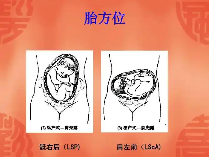 胎方位 骶右后(lsp) 肩左前(lsca)