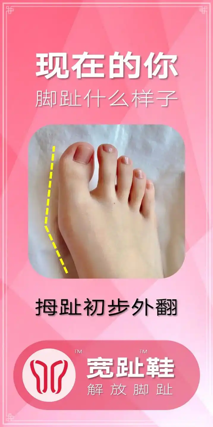 尖头鞋是拇外翻的罪魁祸首.宽趾鞋,解放脚趾,左右两条直线,还 - 抖音
