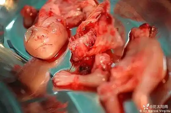 医学摄影图片堕胎手术