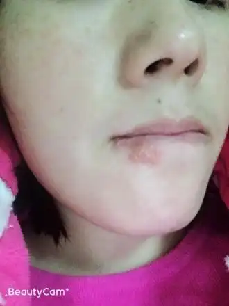 嘴皮上长水泡怎么办 嘴皮上长水泡怎么办很痒