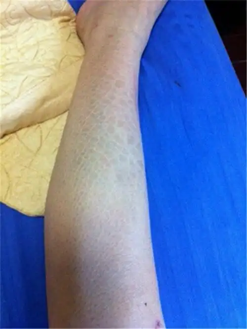 角样鱼鳞病图片_有来医生