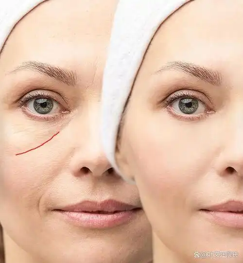 在面部美容领域,印第安纹一直是一个备受关注的话题.