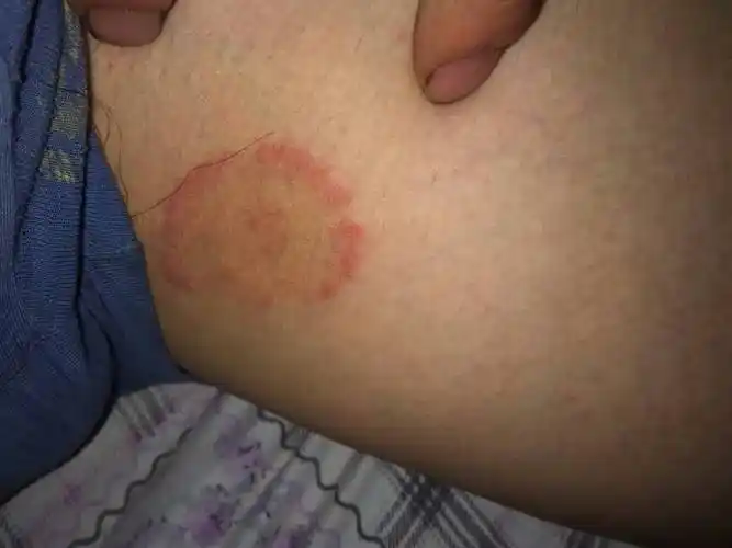 这是什么皮肤病?有点痒!而且还在扩大!在大腿内侧根部