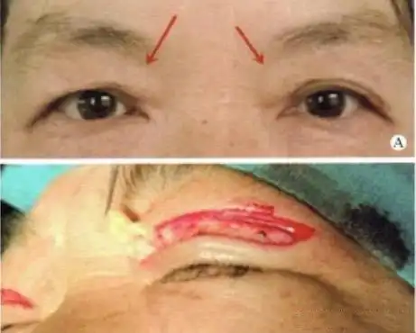 上眼睑下垂,做双眼皮手术,能保持多长时间?
