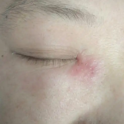 问:眼角长了一堆疙瘩,红肿,不摸的时候会觉得痒,按压会疼.男,34岁.