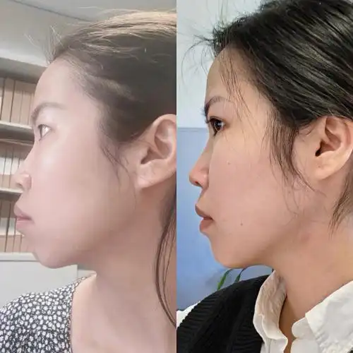 90后大龄女青年正畸路之牙套脸