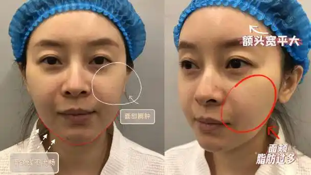 脂肪修复##脂肪填充失败修复##张立彬的案例集