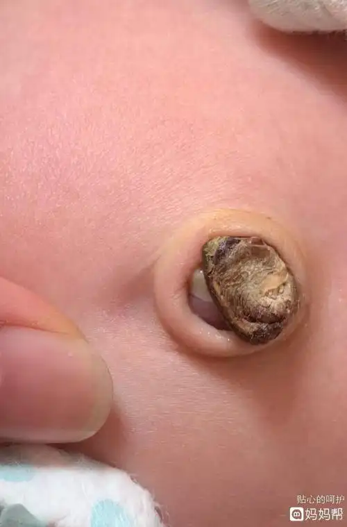 肚脐有分泌物还发臭(肚脐有分泌物还发臭是什么原因还痒)