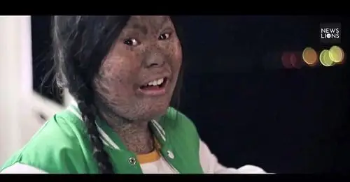 所以皮肤看起来可能会像鱼鳞,也可能会像蛇皮,"但是,听到其他人嘲笑我