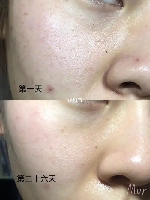 alpha果酸10%使用对比_果酸_刷酸_收缩毛孔_alpha hydrox怎么样_颗粒