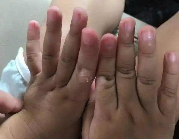 宝宝总喜欢吃手指抹辣椒都戒不掉只因没有一个安全的替代品