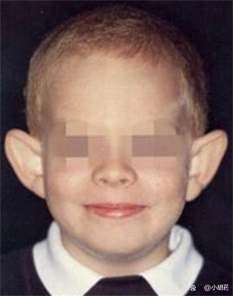 "穷人耳","富人耳",是什么原因导致了耳朵形态各异呢?