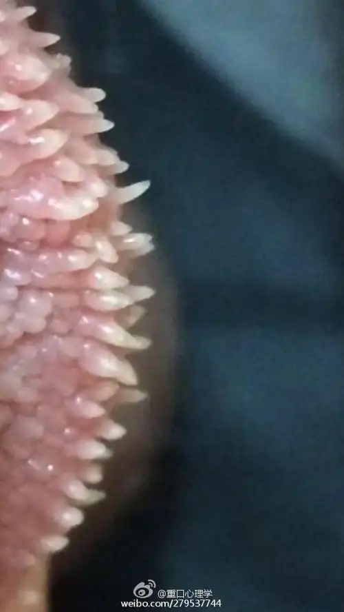 papillaris genitalis),又称为阴茎珍珠样丘疹病,冠状沟或龟头丘疹