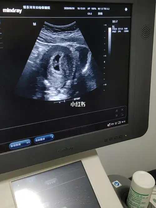 有胎心胎芽啦,可以建档啦,宝宝很健康!开心,希望一路顺利