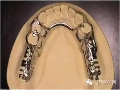 可摘局部义齿铸造支架修复中常见的卡环种类及作用