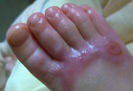 烧烫伤的家庭处理方法值得收藏!