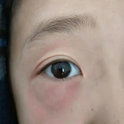 孩子这两天眼睛痒,眼皮下面起包,想知道是什么原因,如何治疗