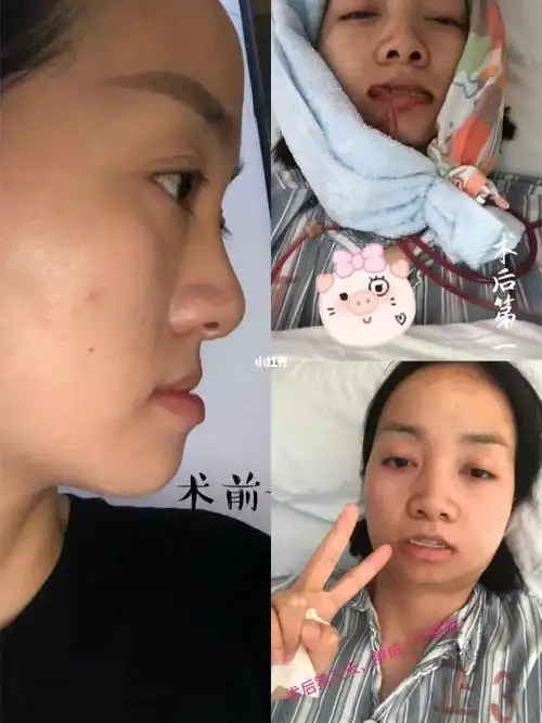 正颌术前术后对比