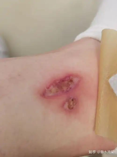 热水袋低温烫伤记录图片