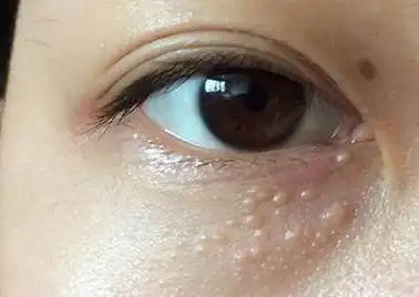 身上起肉粒是怎么回事(男性长小肉粒是什么原因)