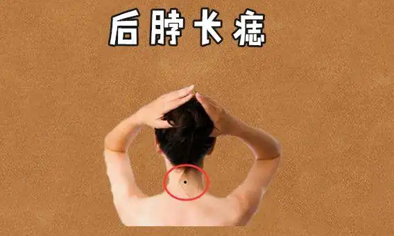 后脖长痣通常在后脖的位置处长有吉痣,被称之为"靠山"痣,而长有此种吉