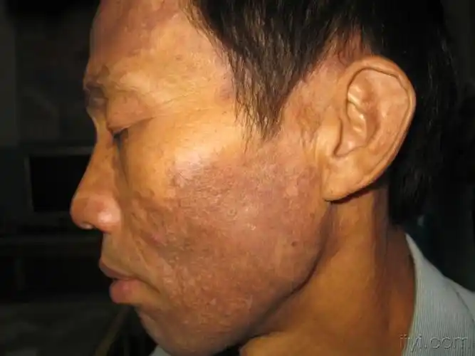 送煤气工皮肤黑变病