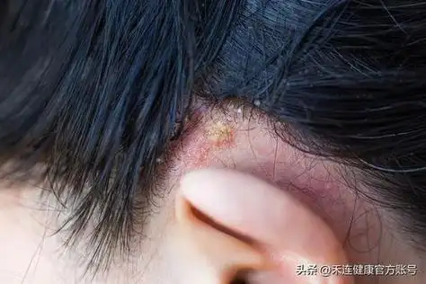 头皮红色毛囊炎图片 - 搜狗图片搜索