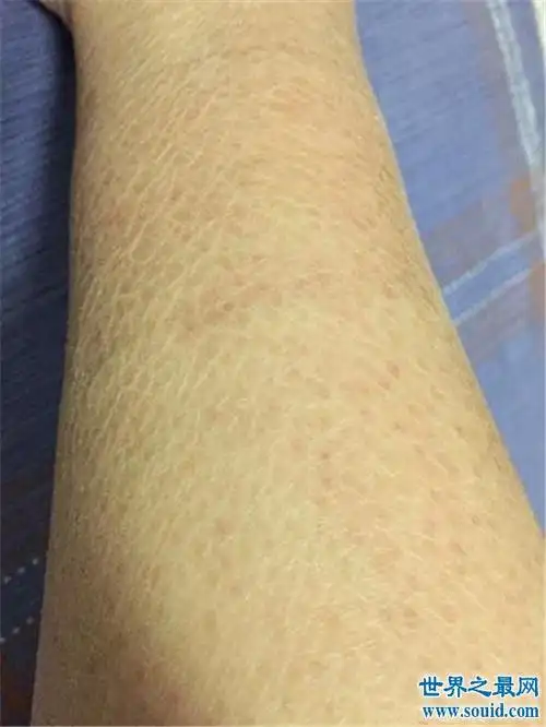 美国女婴全身长满鳞片,其实这是一种罕见的皮肤病!