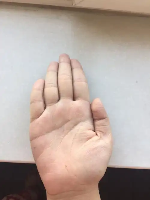 手掌长痣在生命线上(手掌生命线有痣代表什么意思)