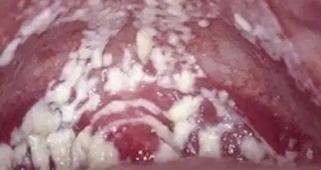 【霉菌性阴道炎】真的是里面"发霉"了吗?怎么办?