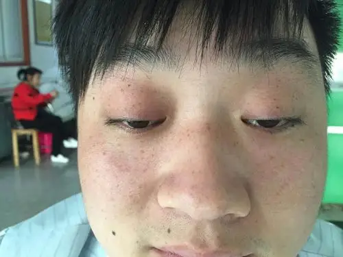 眼皮下垂很可能是重症肌无力惹的祸