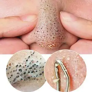 3瓶去黑头粉刺清洁缩小毛孔粗大面膜补水紧致修复收缩毛孔精华液