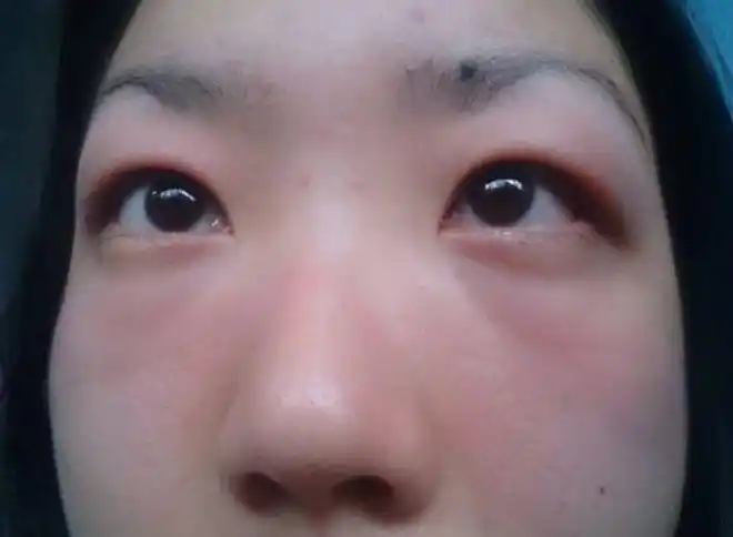 尿毒症光临之前,身体可能会发出3个信号,可惜很少有人察觉