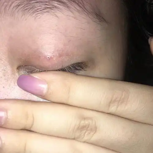 线头,双眼皮形已经恢复很自然了,为了避免感染和线结反应还是去清理