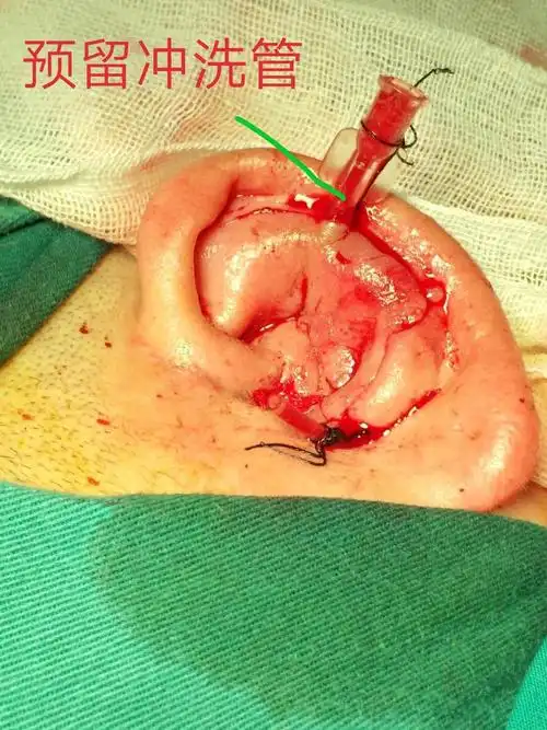 分享两例手术;青少年乳突再根治术及鼓室成型术:化脓性软骨膜炎手术.